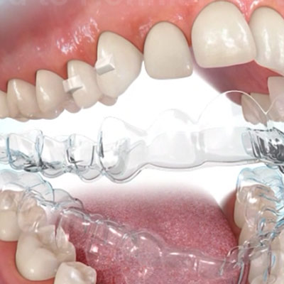 Transparente Zahnschienen / Alignertherapie