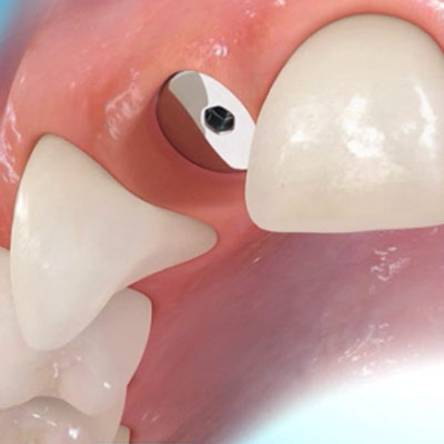 Wenn Zähne fehlen / Implantate / Brücken